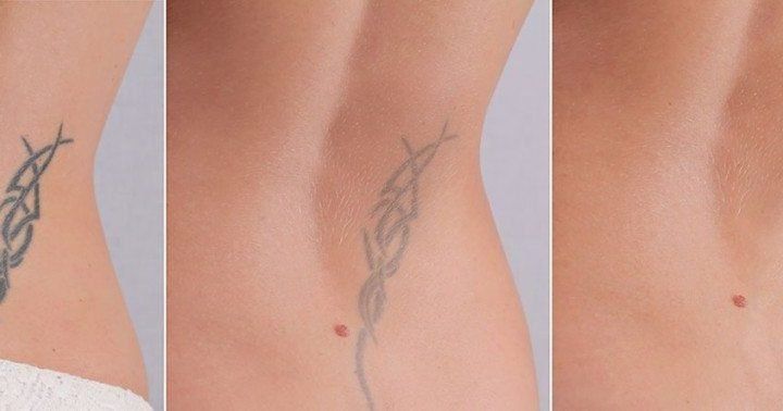 tattooremoval